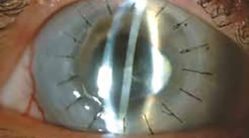 Glaucoma - D'Olhos Hospital Dia