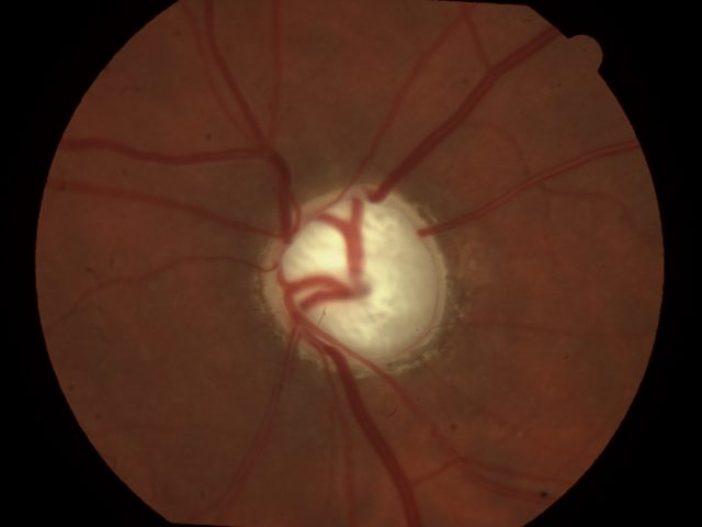 Glaucoma, um perigo silencioso - D'Olhos Hospital Dia