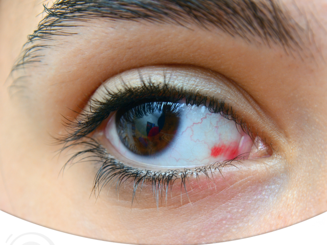 Saiba mais sobre o derrame ocular - D'Olhos Hospital Dia