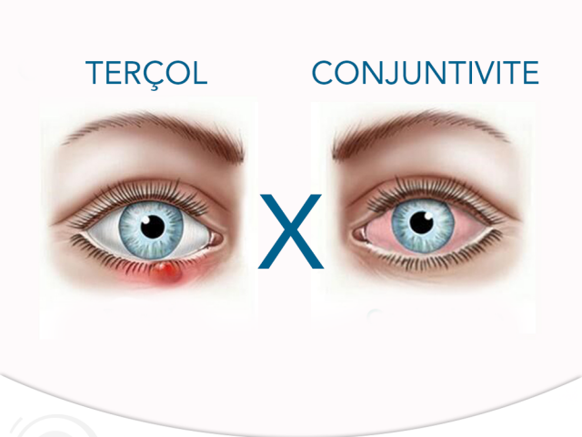 Conjuntivite e Terçol: conheça as principais diferenças - D'Olhos Hospital Dia